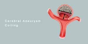 Endovascular Treatment for Cerebral Aneurysms
