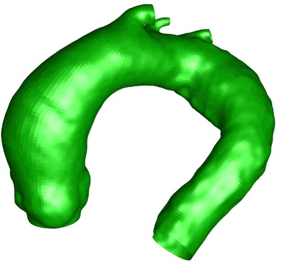 Aneurysm model